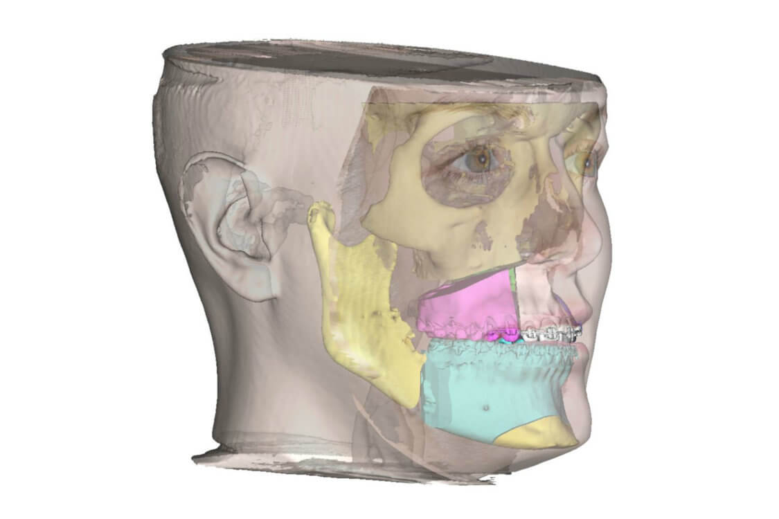Planificación 3D en Cirugía Ortognática
