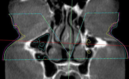 Coronal_EPC1