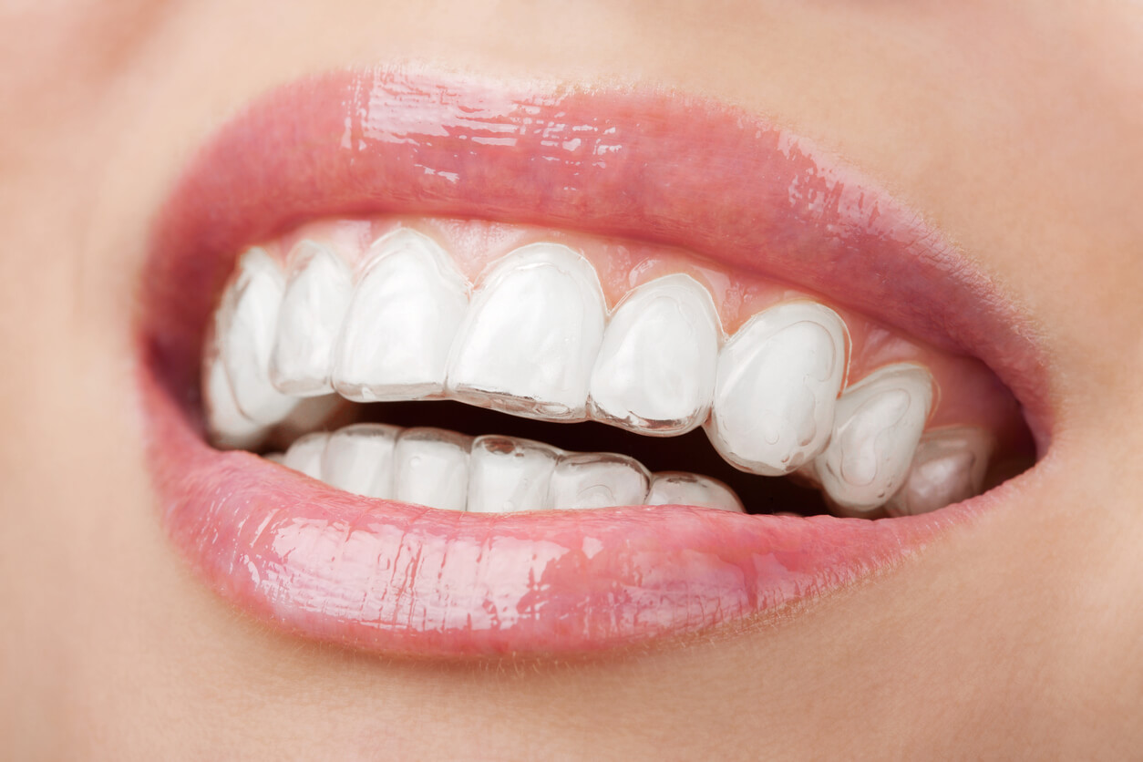 Una ortognática con Invisalign es posible - Instituto Maxilofacial