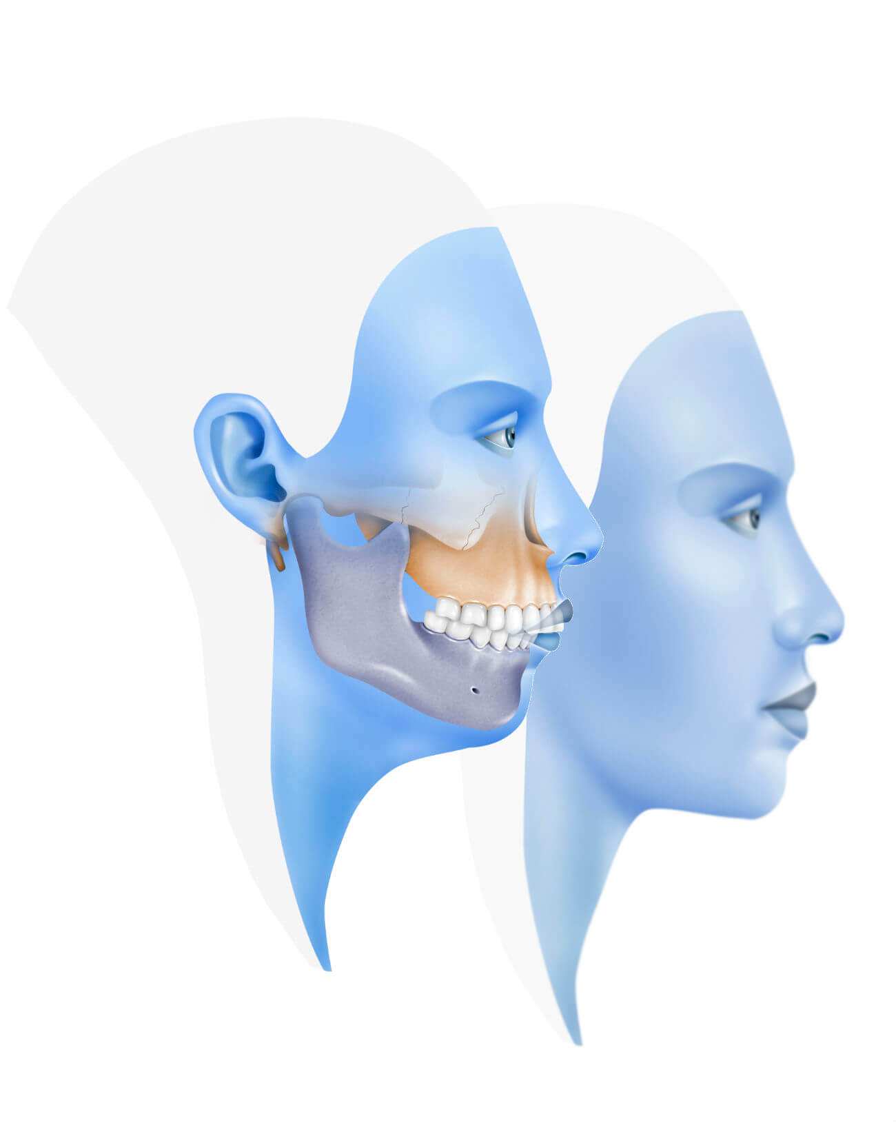 Clase II o Retrognatia Mandibular» Cirugía Ortognática - Instituto  Maxilofacial