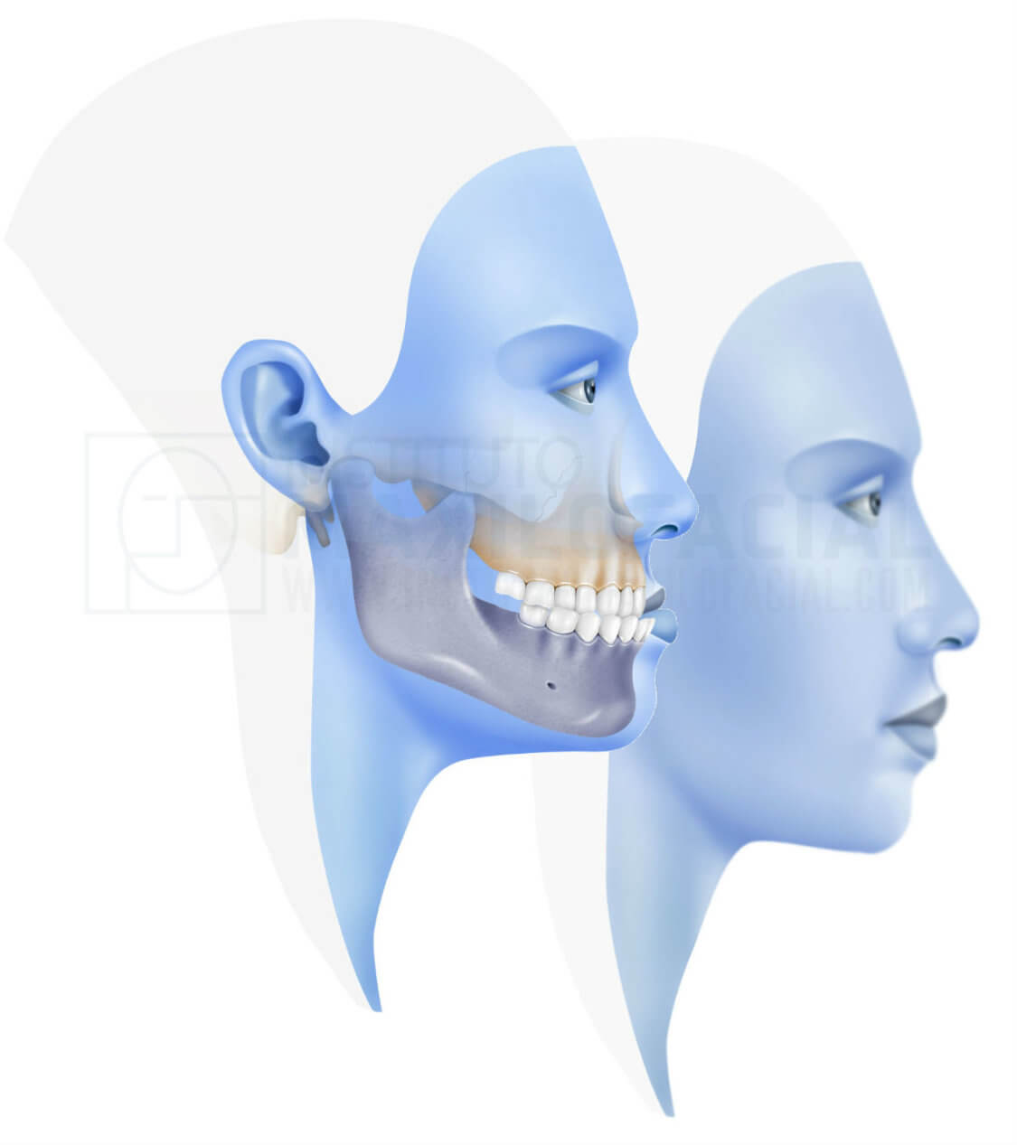 Prognatismo Mandibular o Clase 3 » Cirugía Ortognática - Instituto