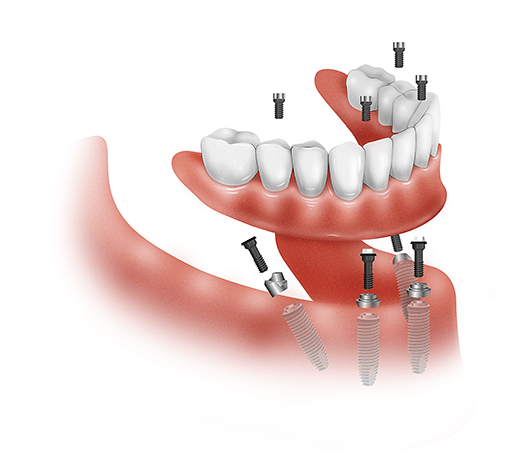 Get a Total Smile Makeover with All-on-4 ® Dental Implants - Lasting Smiles  Dental Care Las Vegas