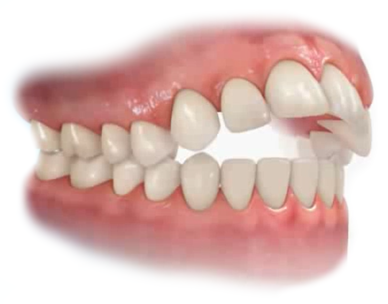 Open Bite Teeth Open Bite Dr Jamilian Open Bite Teeth Open Bite Dr Jamilian