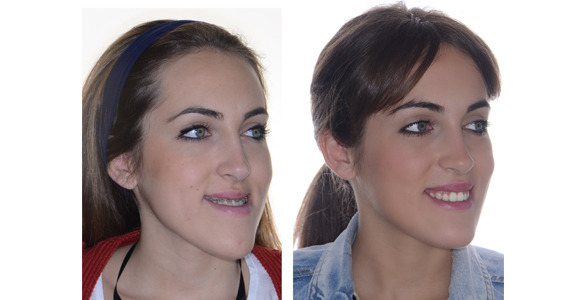Cirugia ortognatica clase 3 antes y despues de adelgazar