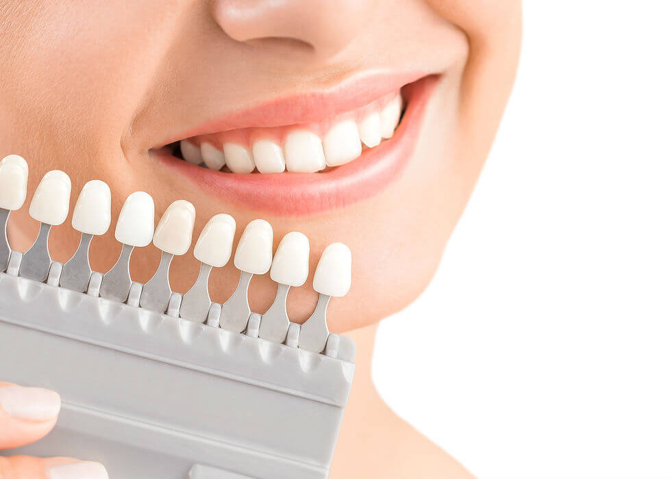 Carillas Dentales - Estética Dental - Instituto Maxilofacial
