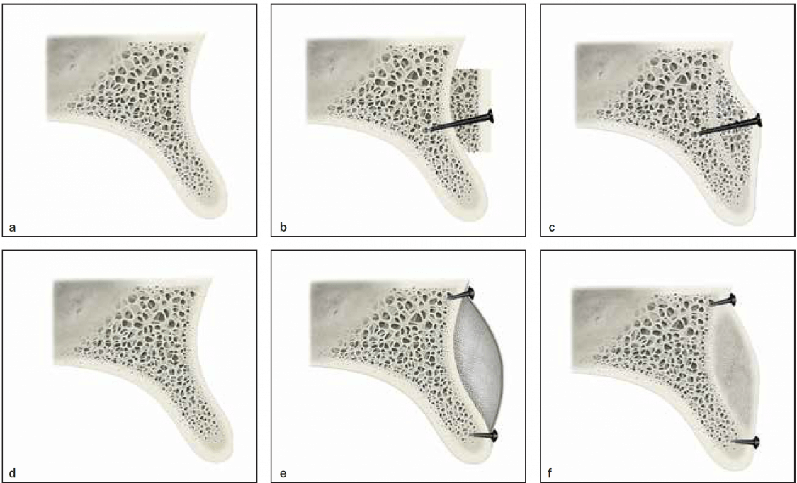 Resorption in alveolar bone grafts Instituto Maxilofacial