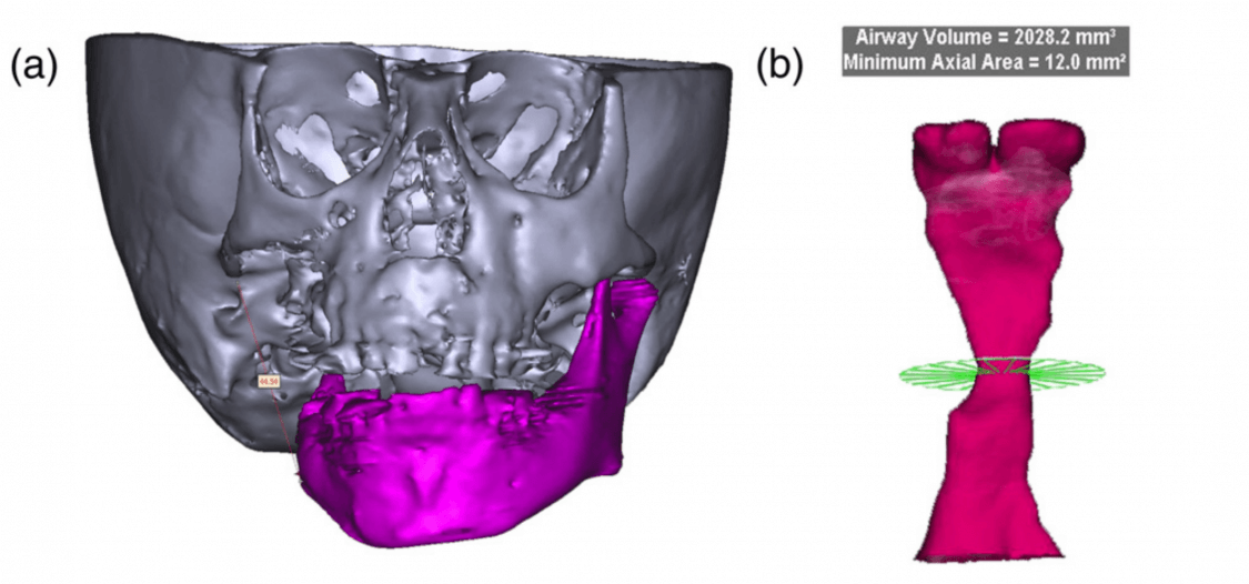 ¿Por qué Planificación 3D para tratar la Apnea del Sueño?