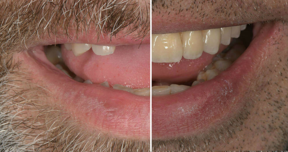 Casos Cl nicos De Implantes Dentales Instituto Maxilofacial