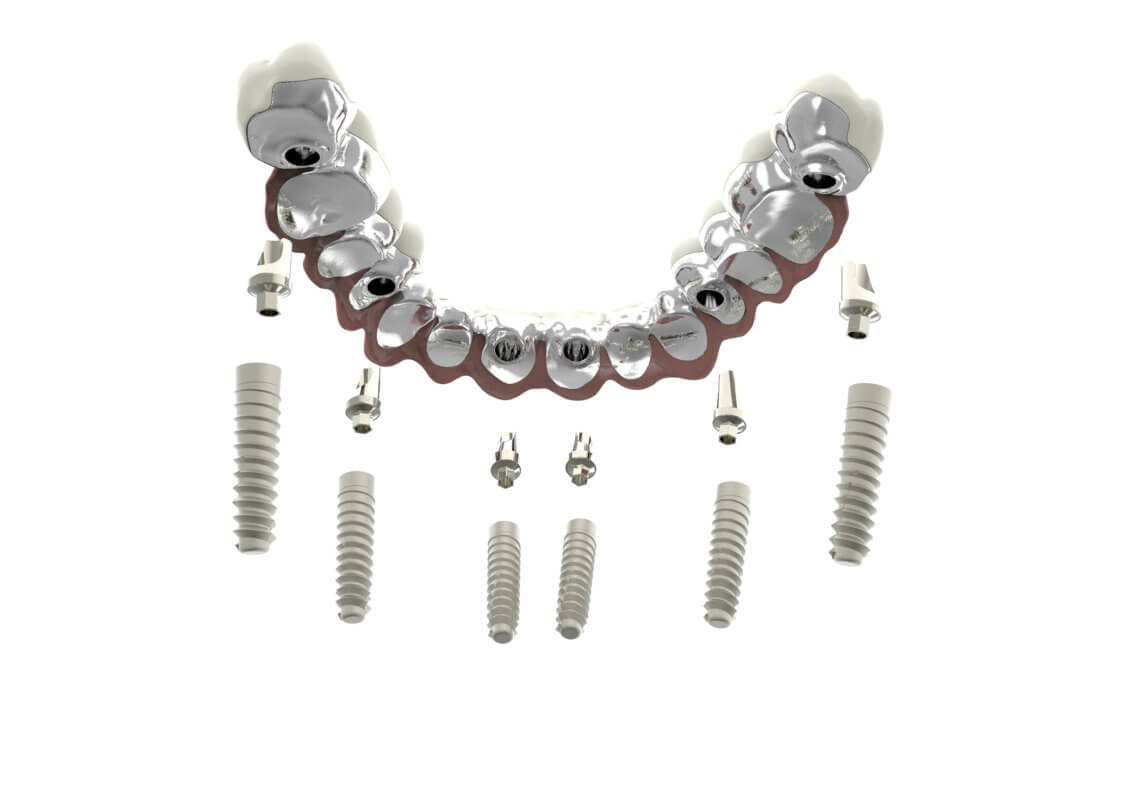 Implantes dentales cigomático y convencional