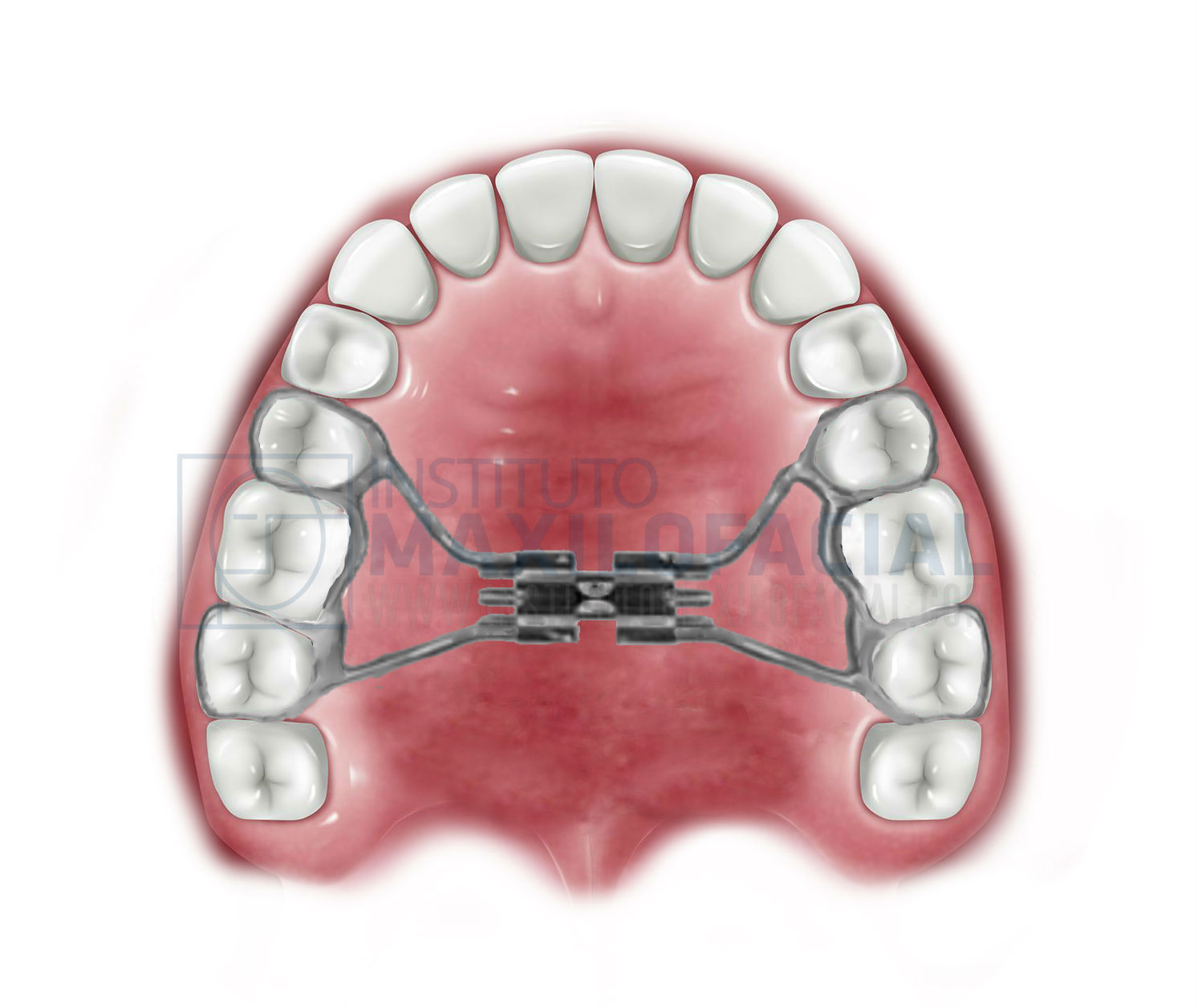 What is a Rapid Maxillary Expander?