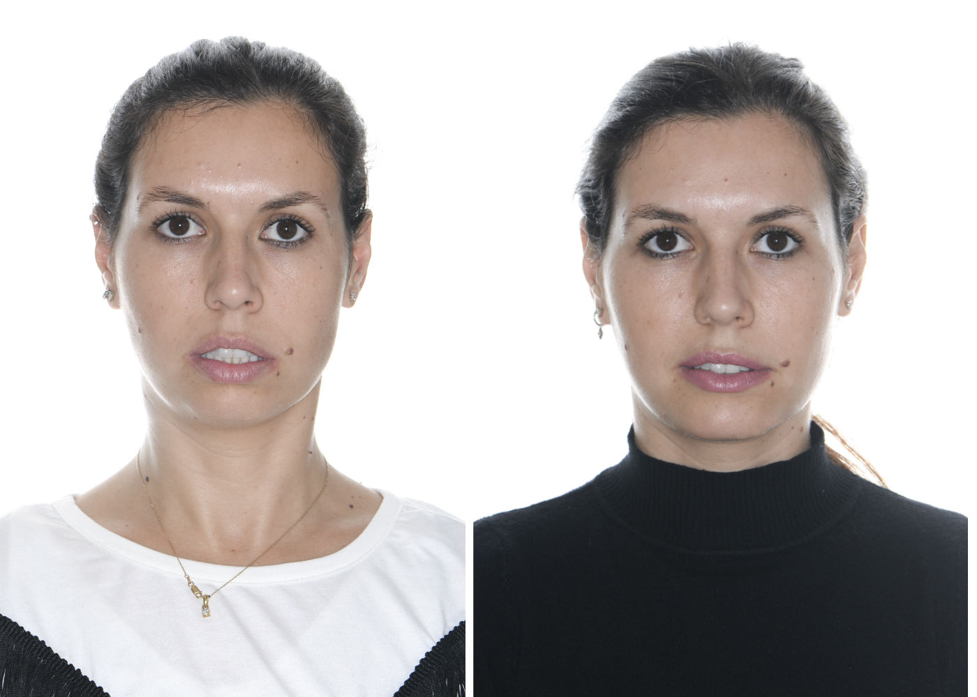 Lifting facial