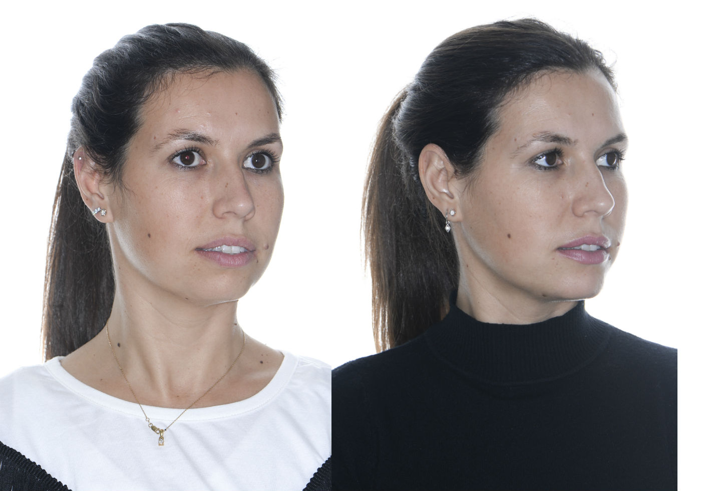 Lifting facial