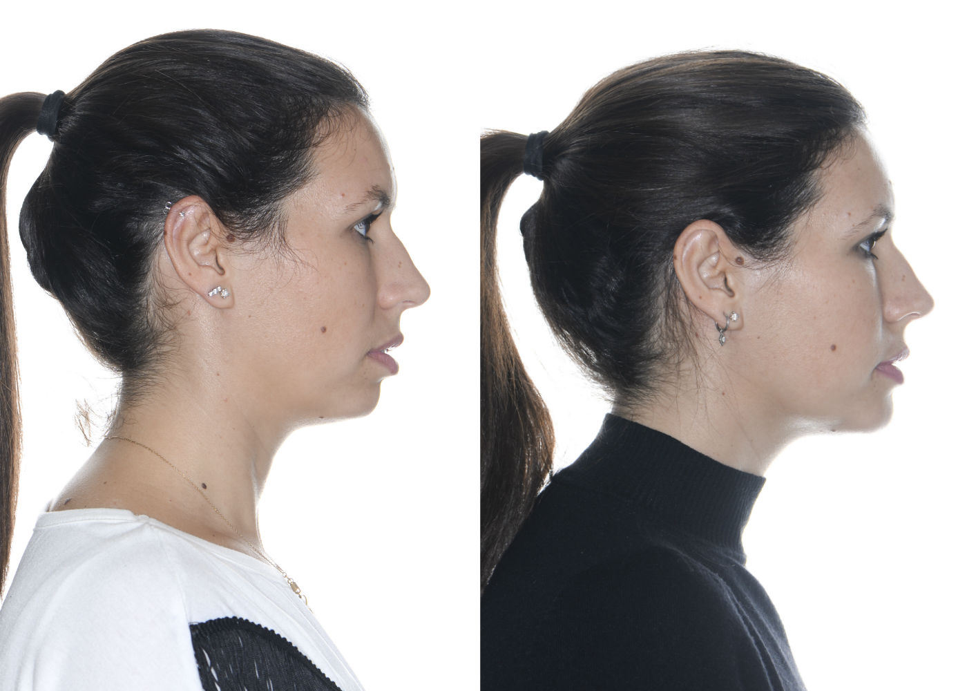 Lifting facial