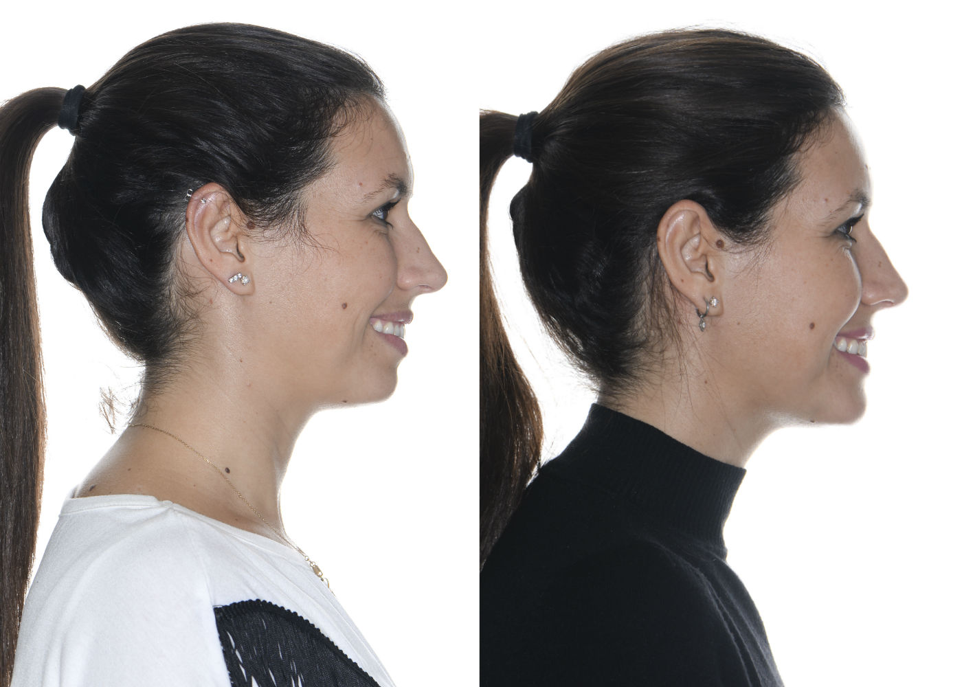 Lifting facial