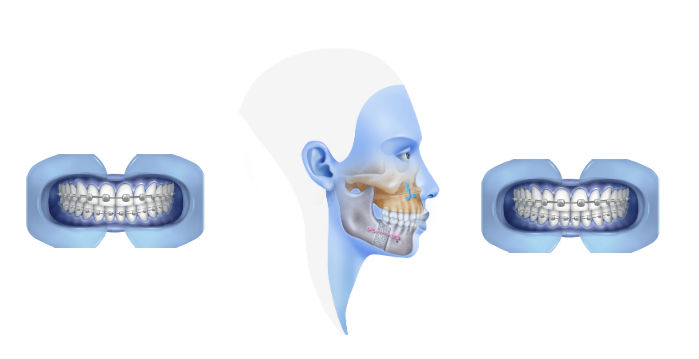 Orthodontics and Orthognathic surgery