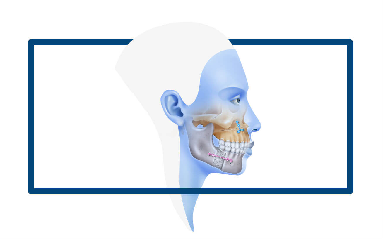 Bimaxillary or maxillomandibular orthognathic surgery Instituto