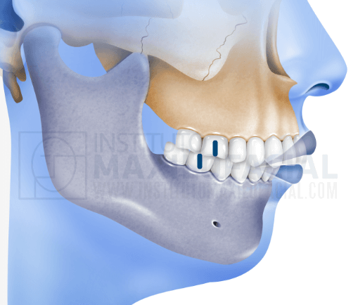 What is a class I, class II or class III bite? - Instituto Maxilofacial