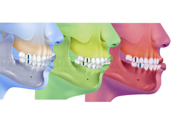 What is a class I, class II or class III bite? - Instituto Maxilofacial