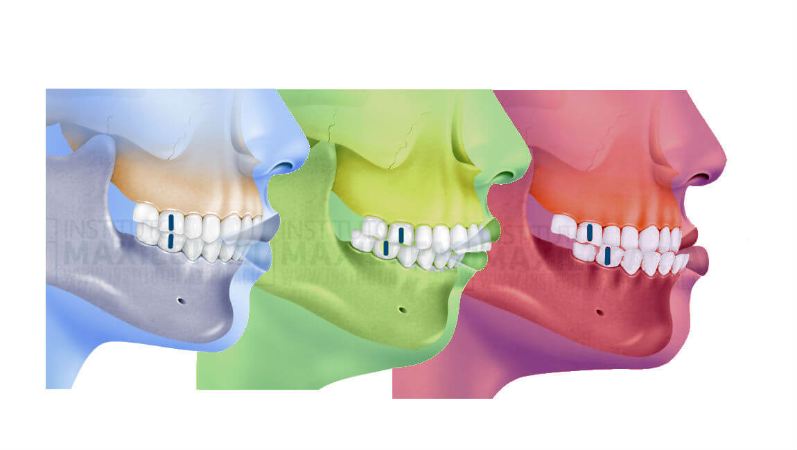 Medalla Procesando observación como se clasifican los dientes Ondas ...