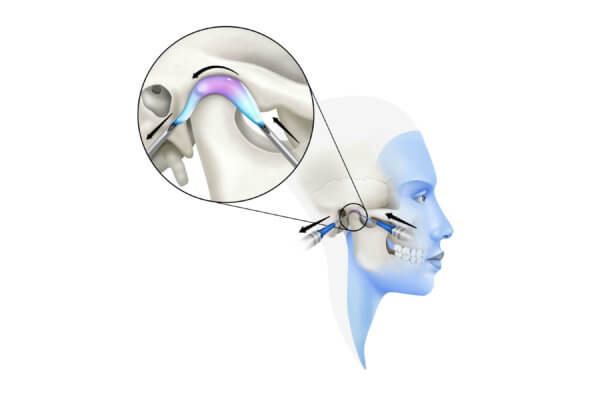 Babosa de mar estoy enfermo Enviar Artrocentesis de la articulación temporomandibular: qué es y para qué sirve  - Instituto Maxilofacial