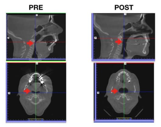 Paciente de apnea del sueño antes y después de una cirugía ortognática de avance mandibular