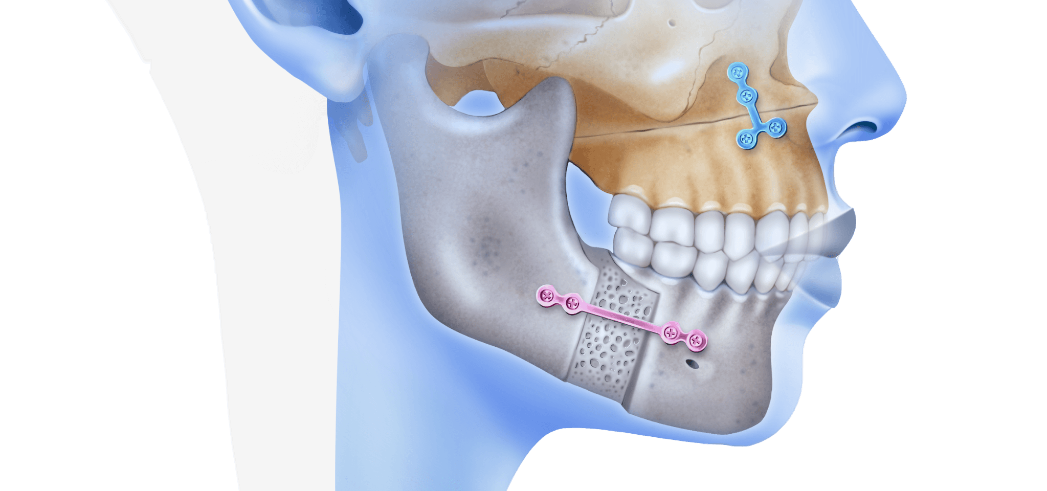 Should plates be removed after orthognathic surgery? - Instituto  Maxilofacial