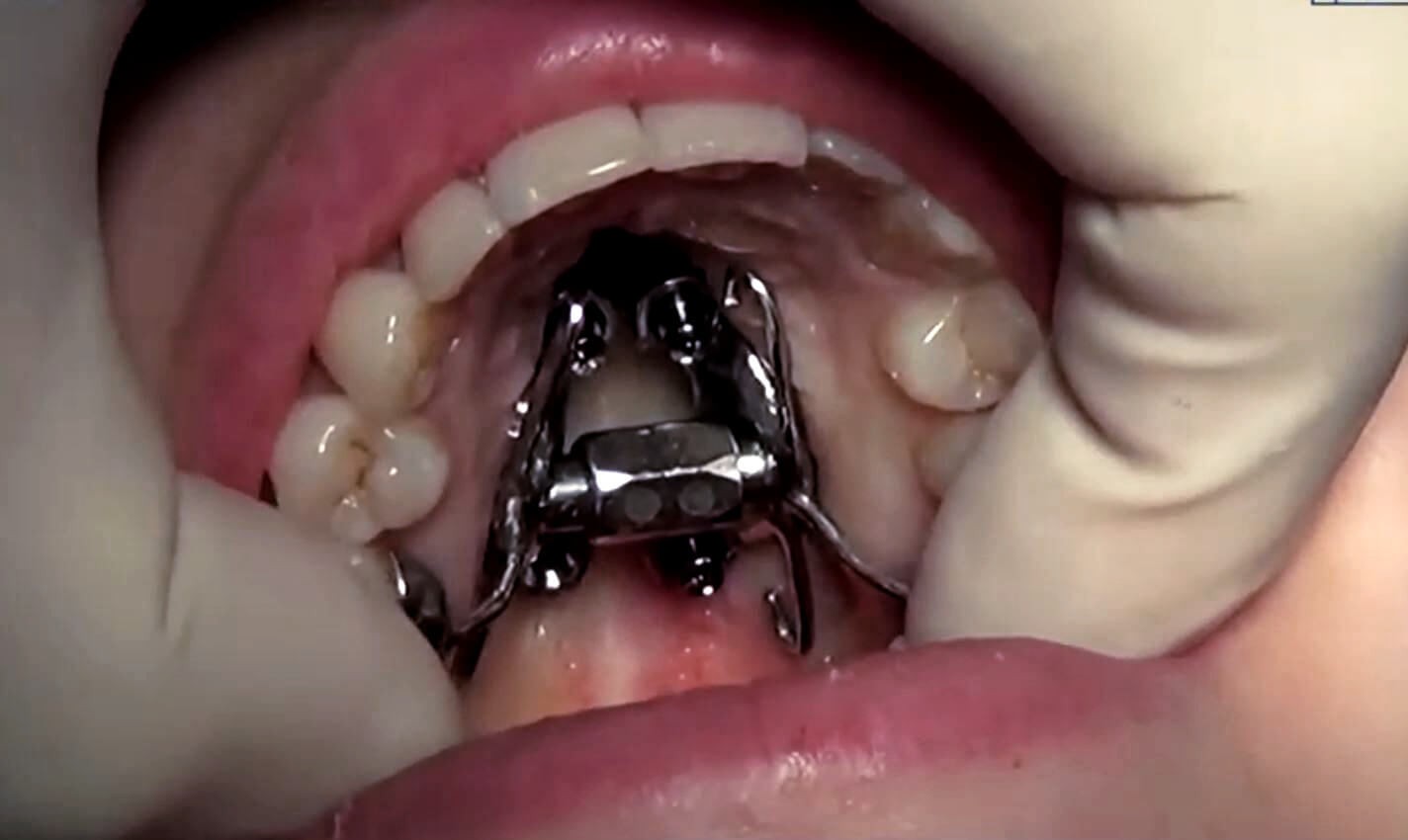 SAMARPE a new, more effective palatal expansion technique Instituto Maxilofacial