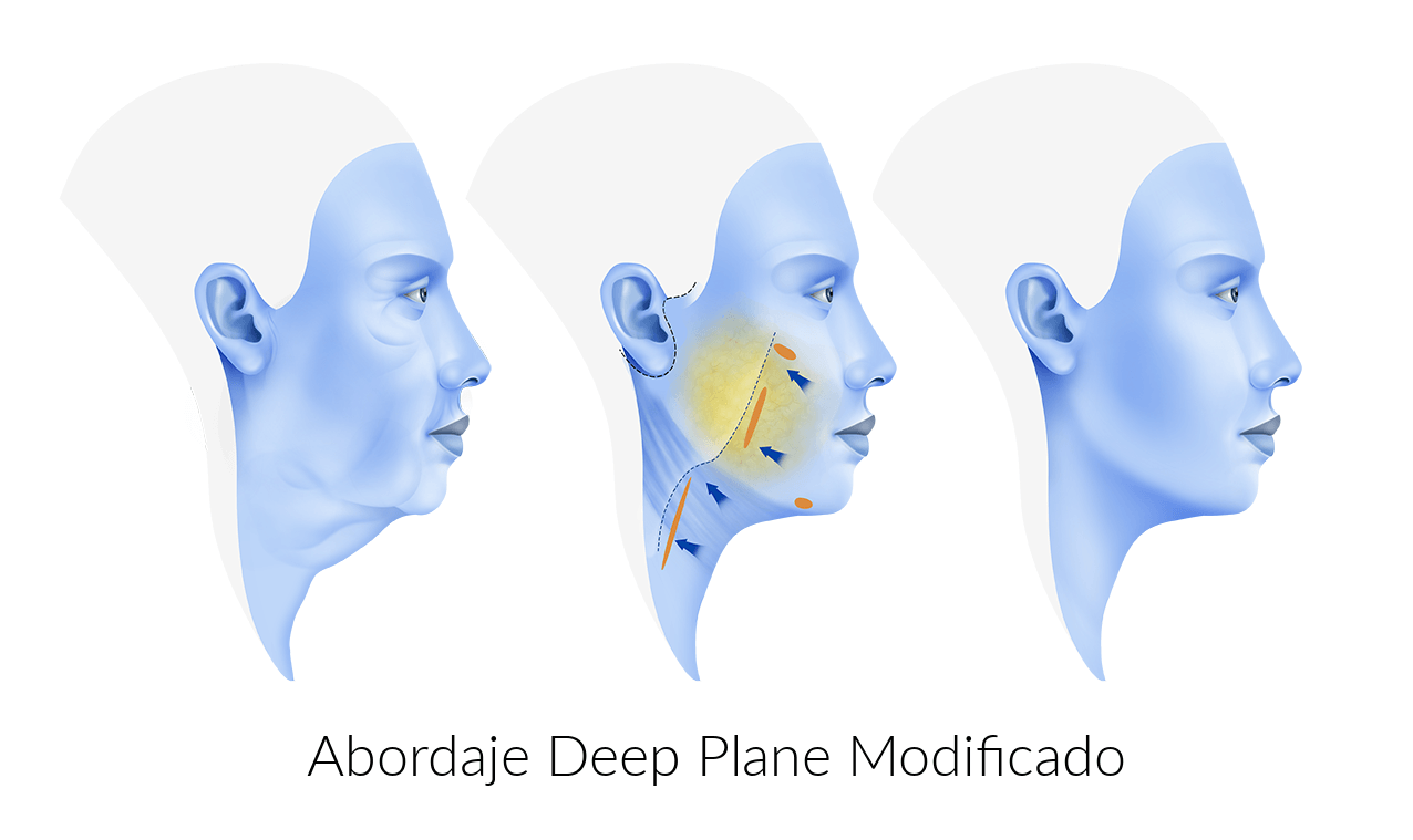 Abordaje Deep Plane Modificado