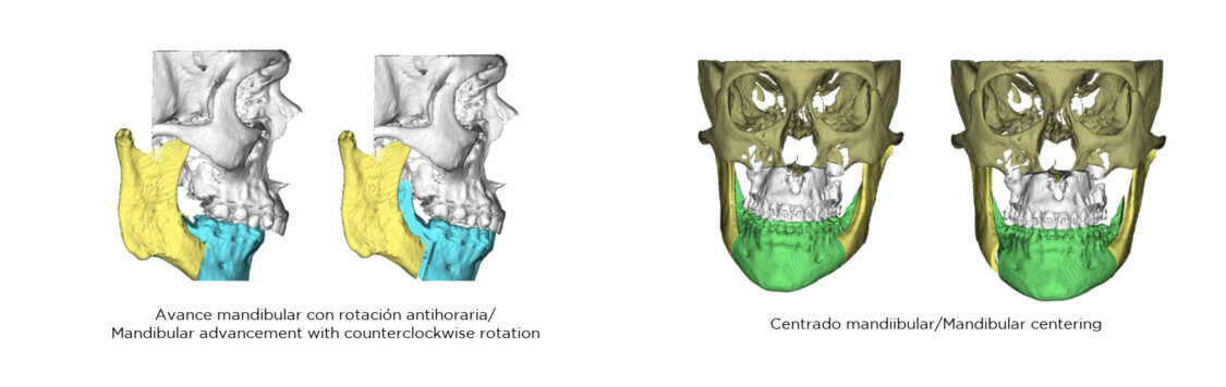 Movimientos mandibulares en cirugía ortognática