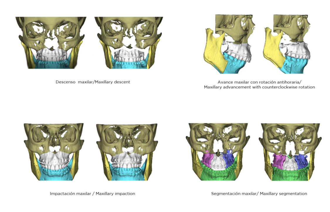 Maxillary movements in orthofacial surgery