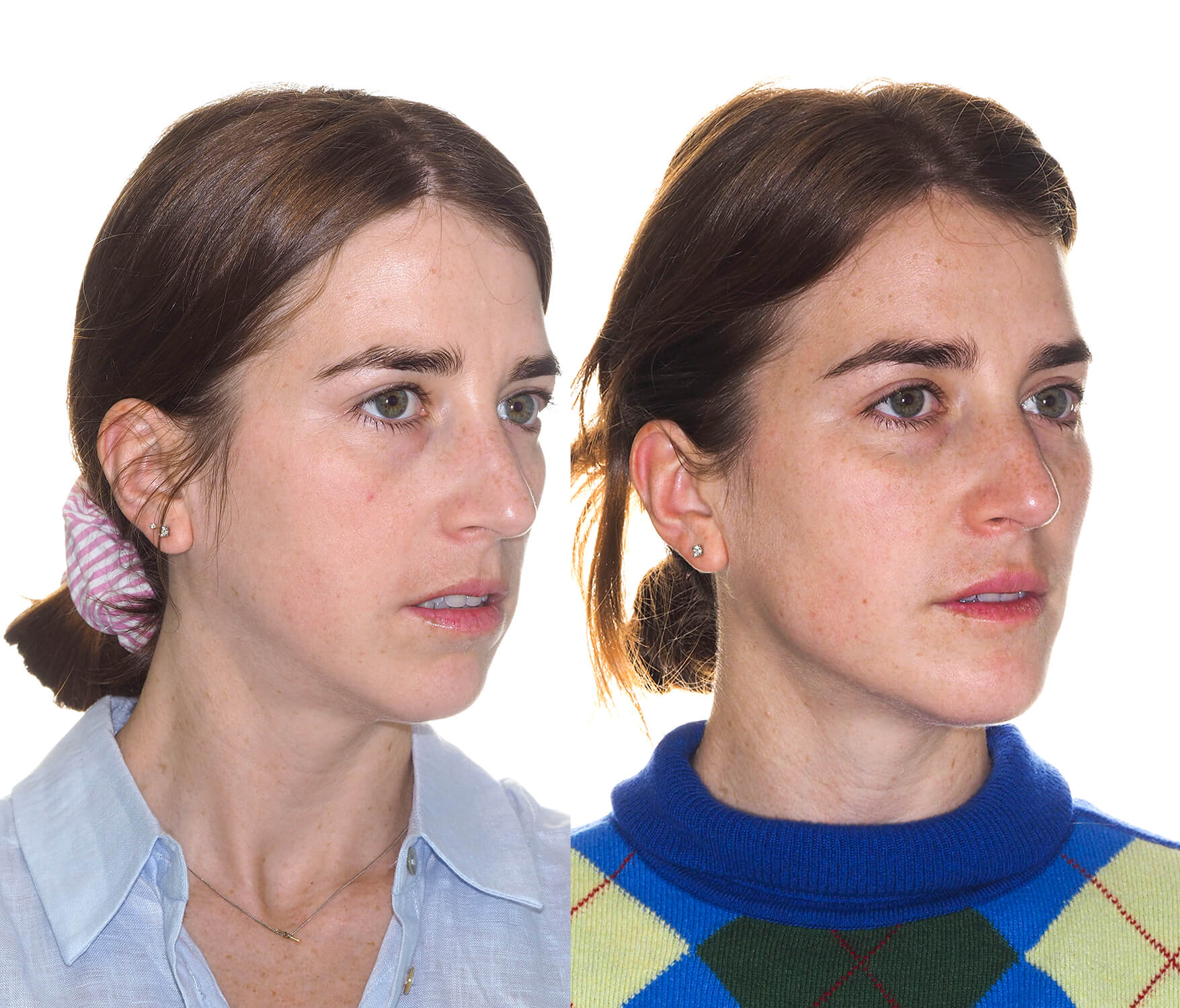 Lifting facial