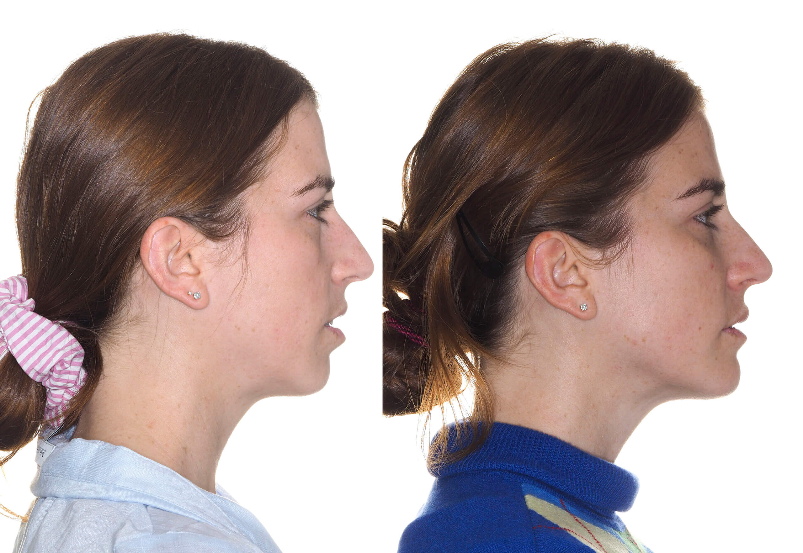 Lifting facial