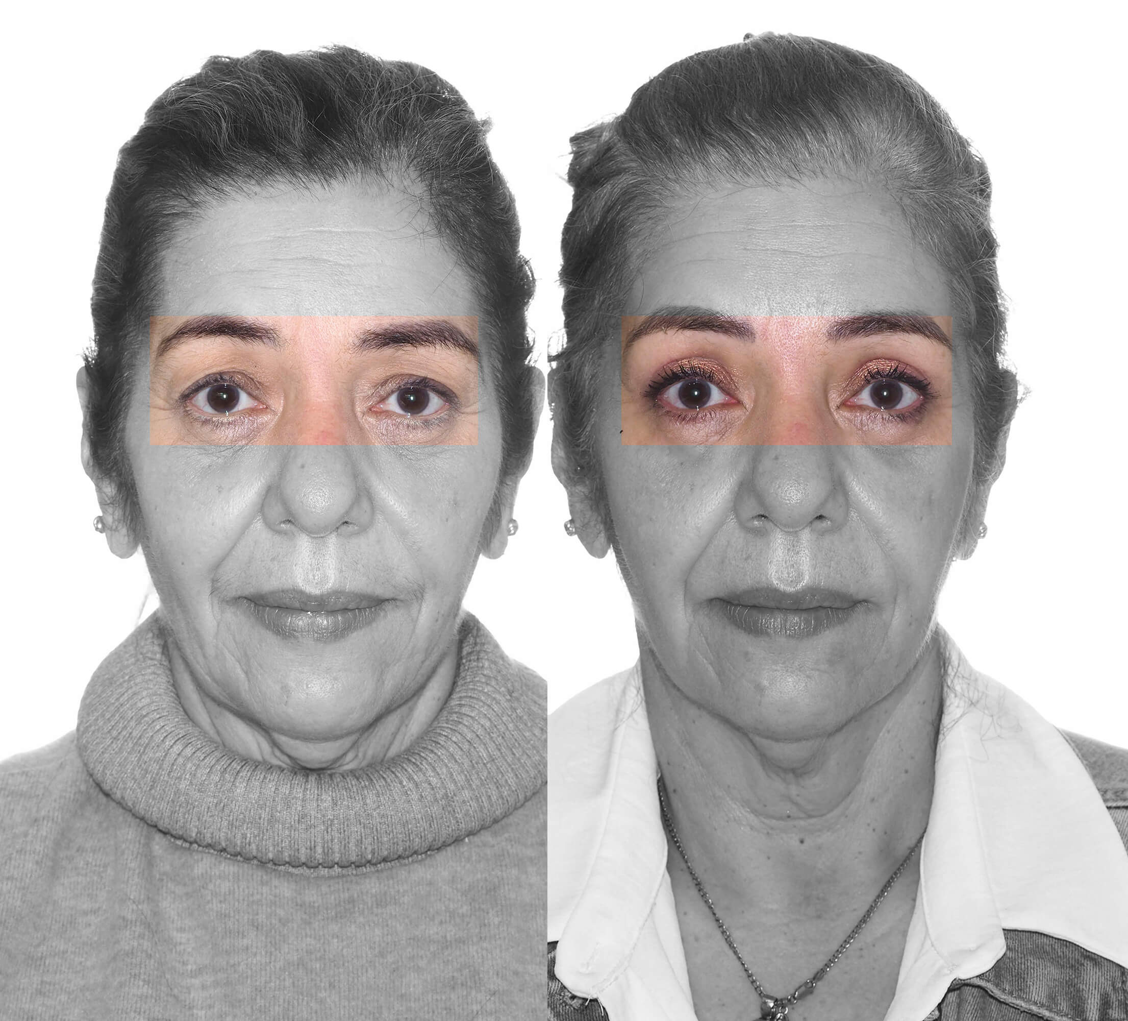 Lifting facial