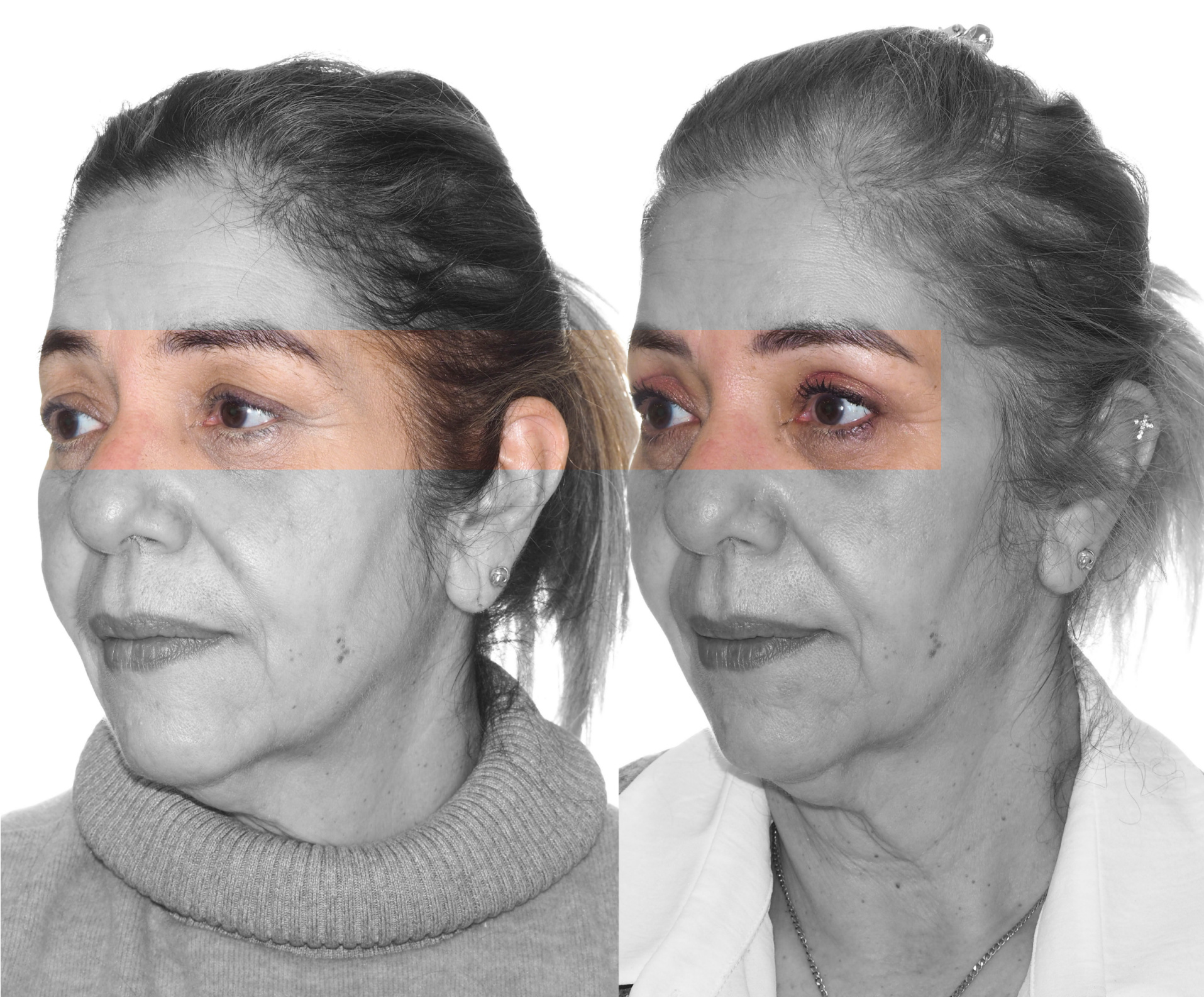 Lifting facial