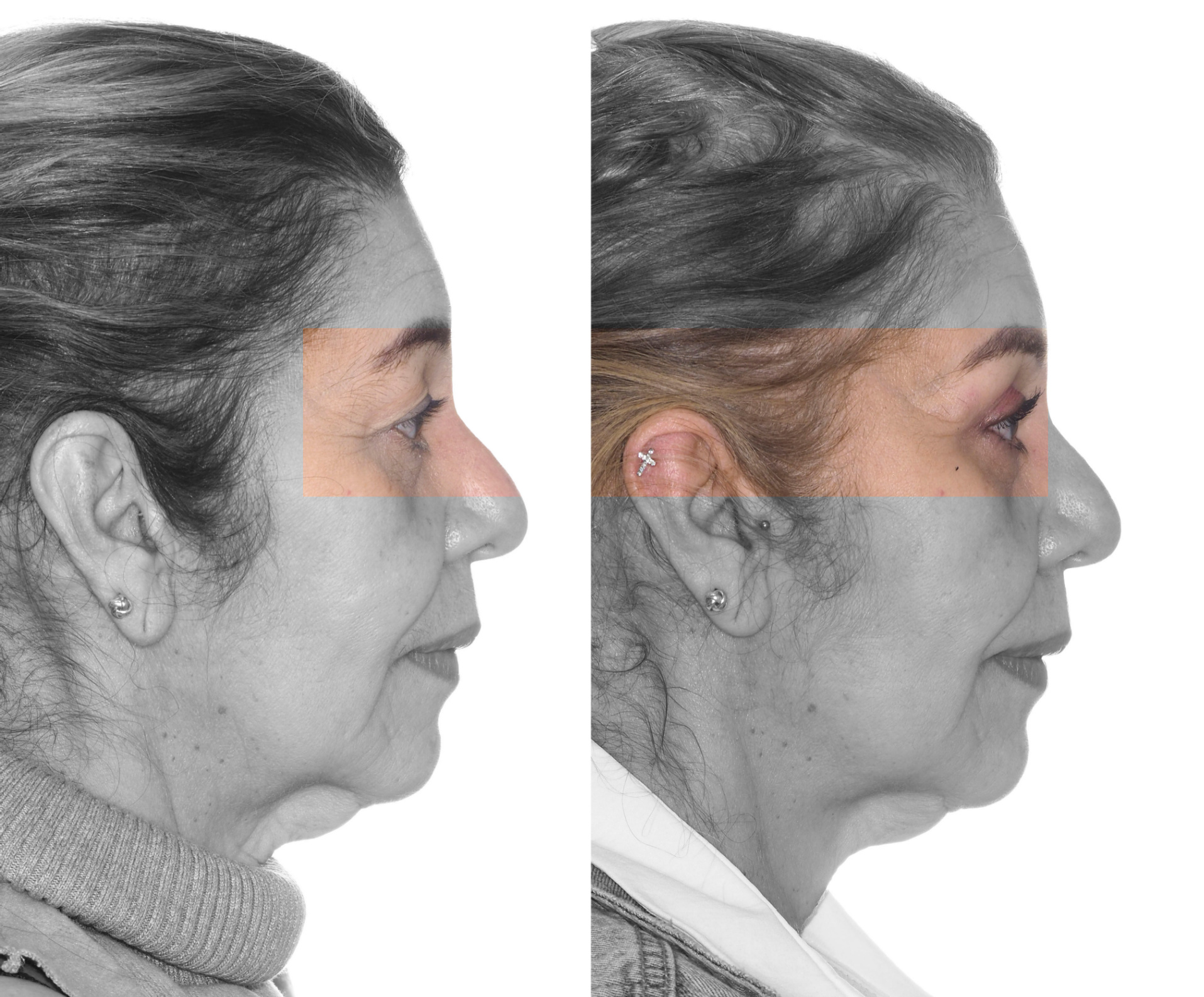 Lifting facial