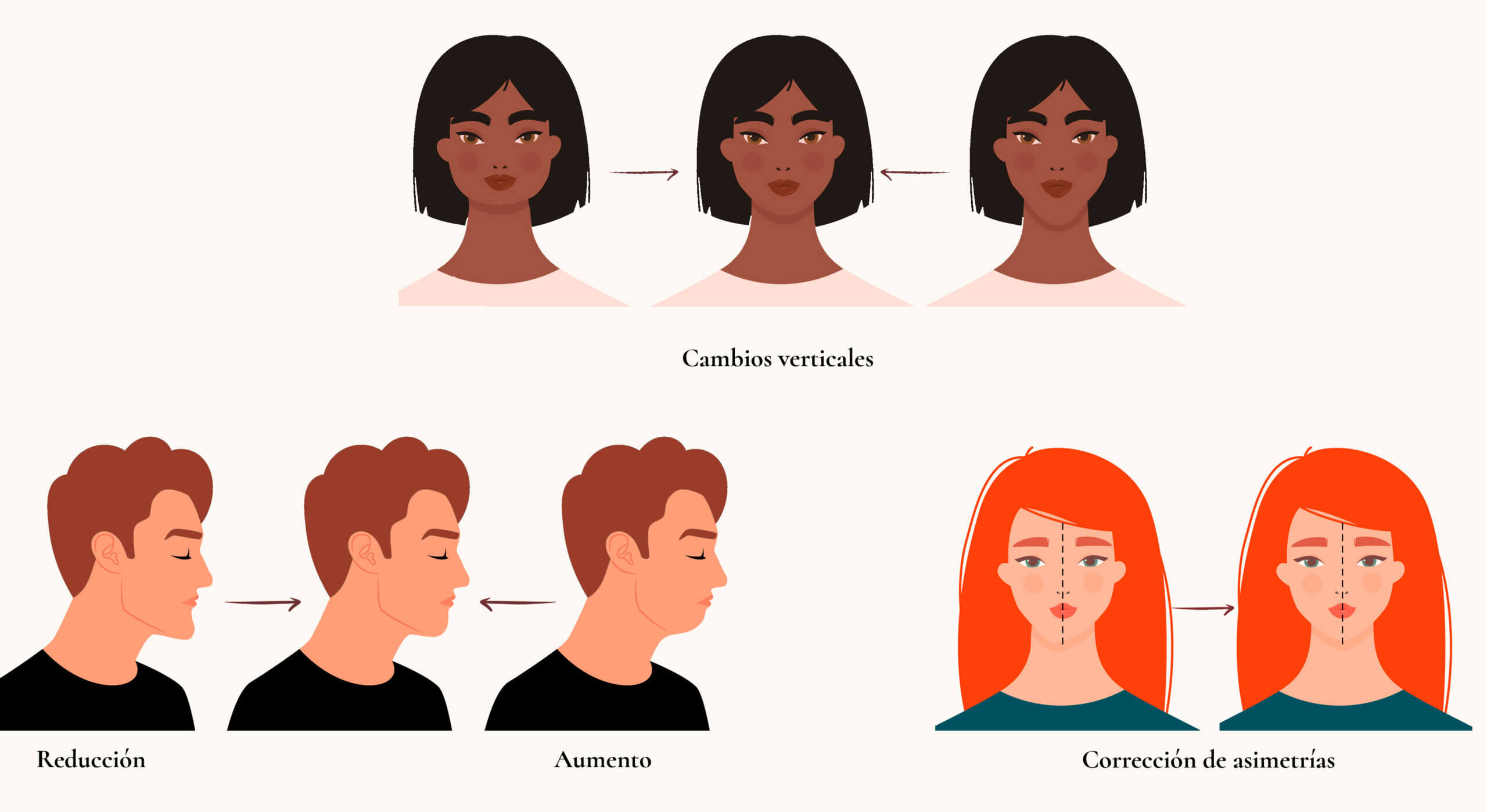 Los distintos tipos de mentoplastia