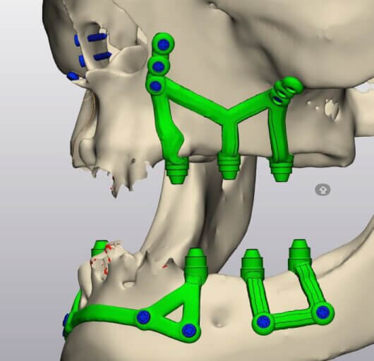Implantes subperiósticos en Instituto Maxilofacial Barcelona