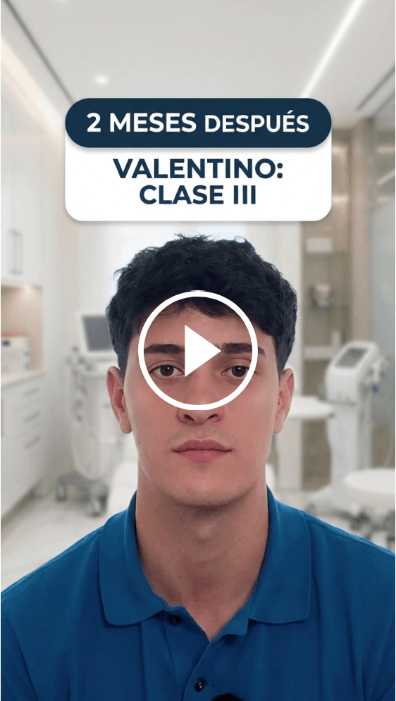 Portada del vídeo testimonio de Iván, paciente de cirugía ortognática con cirugía bimaxilar en Instituto Maxilofacial